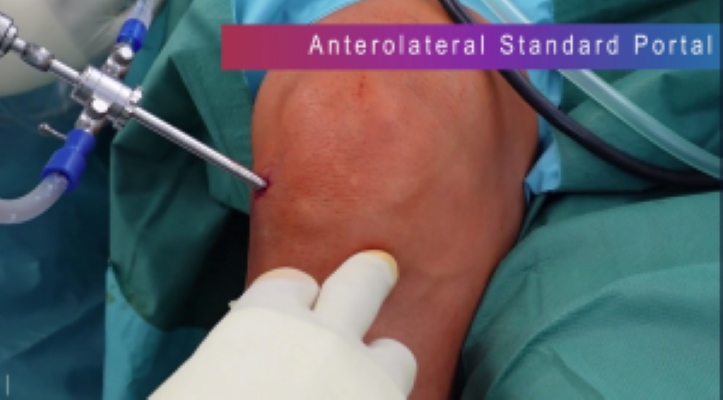Winglet Originals #014: Basics in Knee Arthroscopy – thumbnail 4 of 19