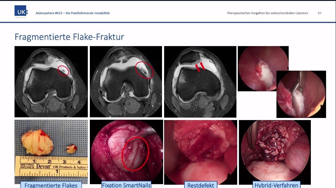 AGAnywhere Monthly - #022: Die patellofemorale Instabilität – thumbnail 4 of 12