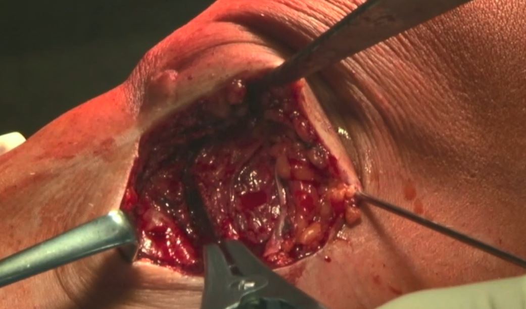 #196: Insights from the OR - Kniegelenknahe Osteotomien – thumbnail 4 of 9