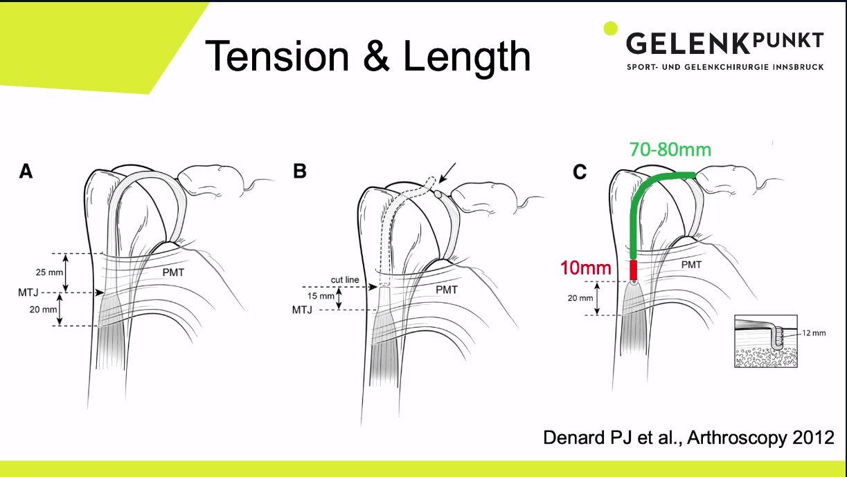 Across the Atlantic: American and European Insights on All Things Biceps Tendon – thumbnail 4 of 16