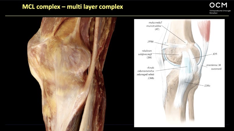 Winglet Originals #001: Acute and Chronic Medial Instabilities of the Knee – thumbnail 4 of 11