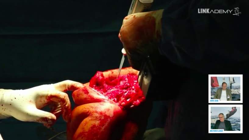 #214: Through the Eyes of the Surgeon - Challenging and Live Knee Revision – thumbnail 4 of 5