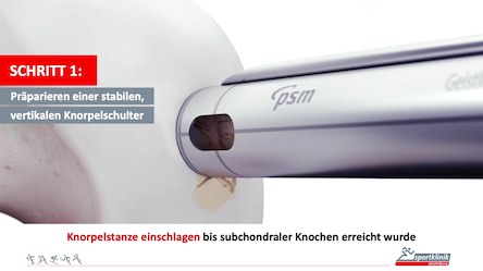 #202: Patienten mit Knorpeldefekten im Kniegelenk  – thumbnail 4 of 7