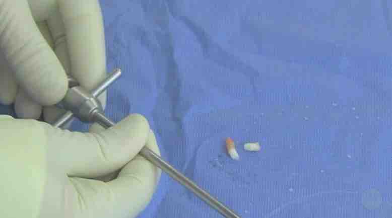 #241: SPHEROX - Surgical Techniques and Expert Tips for the Use of Spherox – thumbnail 4 of 12