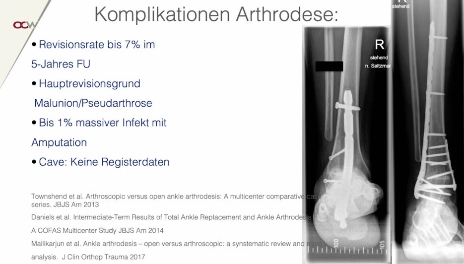 AGAnywhere Monthly - #007: Arthrose am Sprunggelenk – thumbnail 5 of 13