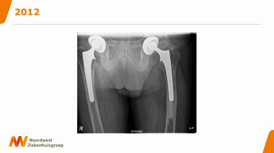 #712: Current Concepts in Femoral Stem Fixation and the Paradox in Clinical Practice – thumbnail 5 of 7