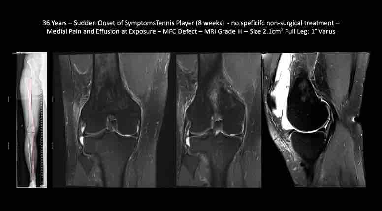 #241: SPHEROX - Surgical Techniques and Expert Tips for the Use of Spherox – thumbnail 5 of 12