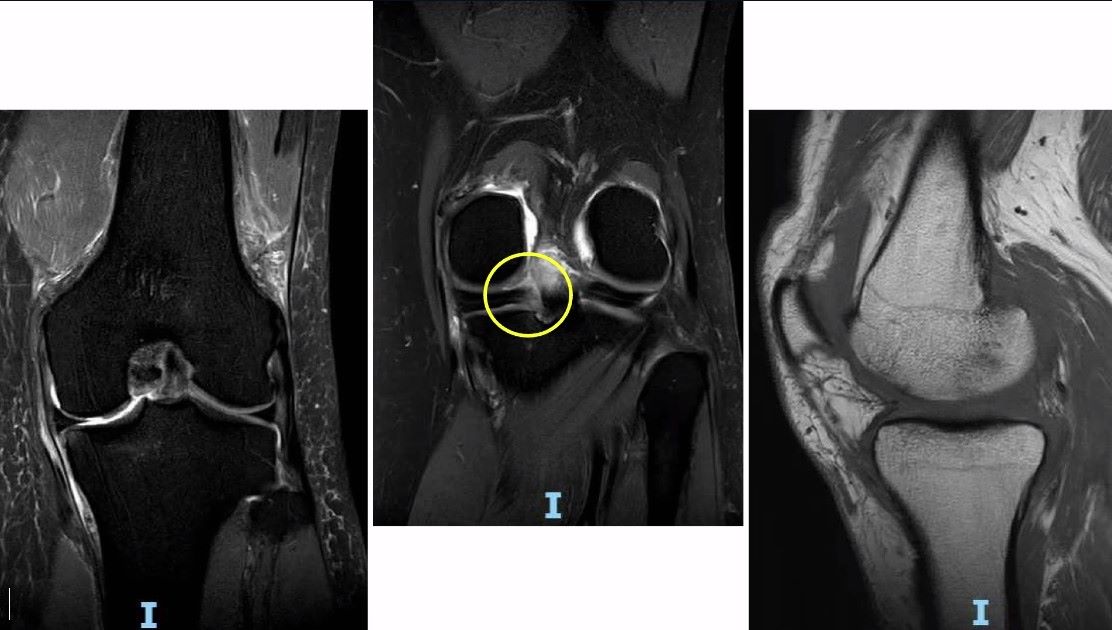 ICRS TV Series - #001: Preserve or Replace in the Aging Athlete: The Debate Continues – thumbnail 5 of 11