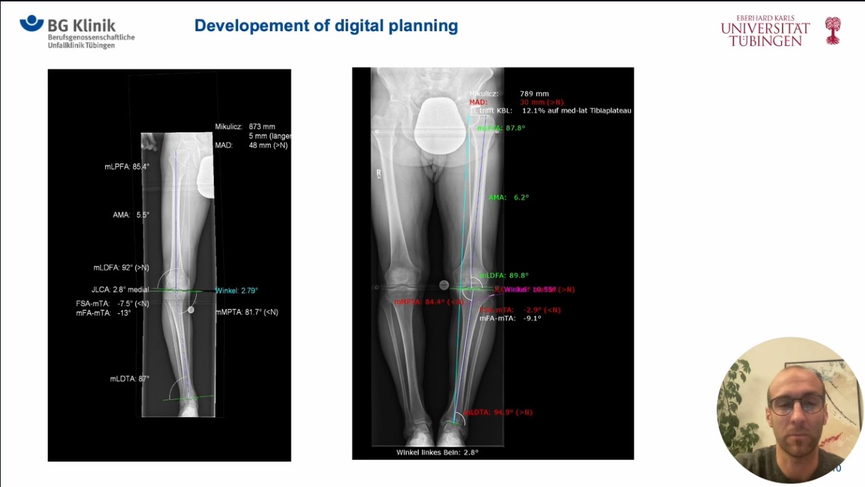 Winglet Originals #022: Osteotomies Around the Knee - Deformity Analysis and its Relevance for Surgical Correction – thumbnail 5 of 12