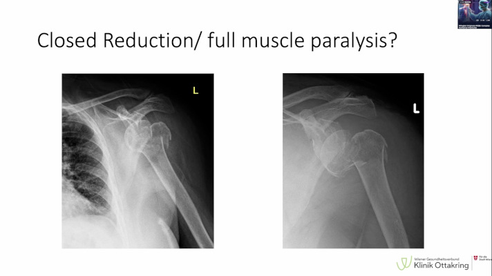 Winglet Originals #028: Complex Humerus Fractures – thumbnail 5 of 11