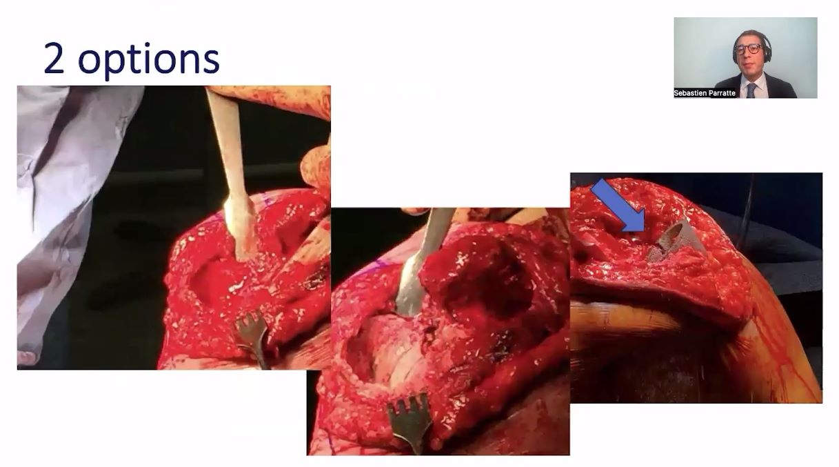 Winglet Originals #015: Revision Knee Arthroplasty – thumbnail 5 of 18