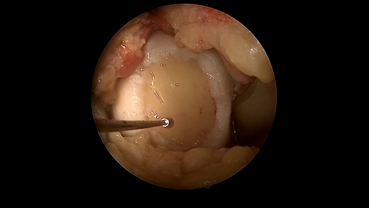 ICRS TV Series - #008: Chondrocyte and Fragmented Cartilage: Products and Procedures – thumbnail 5 of 12
