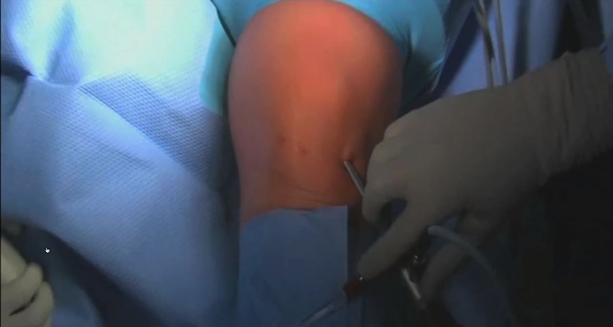 #191: Insights from the OR - Knorpelchirurgie II – thumbnail 5 of 10