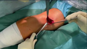 Winglet Originals #011: What Matters in Surgical Cartilage Repair – thumbnail 5 of 12