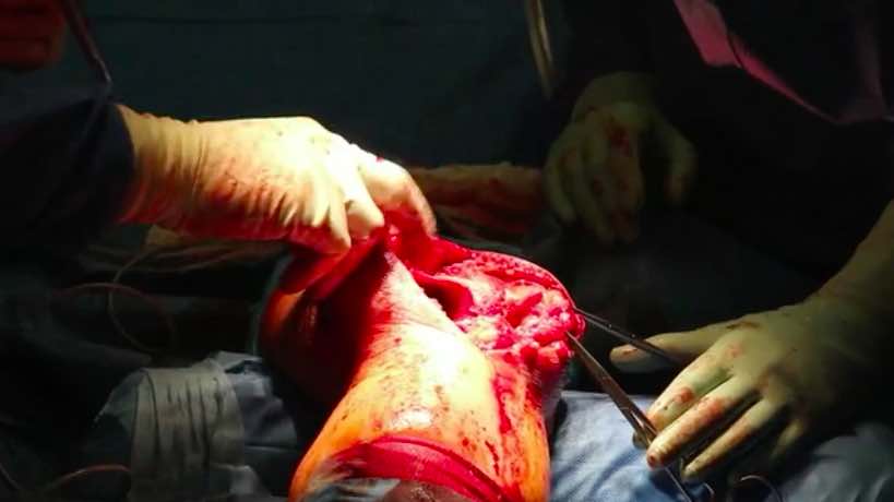 #214: Through the Eyes of the Surgeon - Challenging and Live Knee Revision – thumbnail 5 of 5