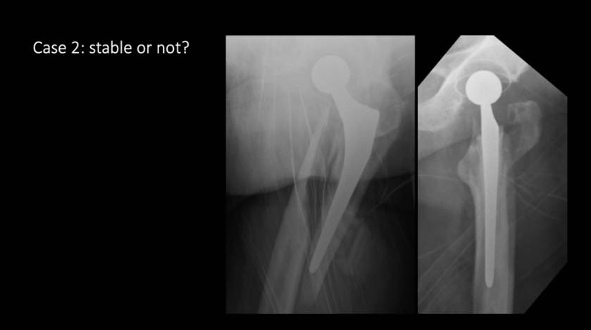 Session 2: Hot Topics in Hip Arthroplasty – thumbnail 5 of 8