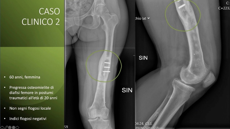 #2211: Prevention of Periprosthetic Joint Infection with Bone Cement in Italy – thumbnail 5 of 9