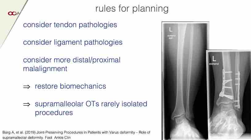Winglet Originals #004: Malalignment and Early Osteoarthritis of the Ankle – thumbnail 5 of 11