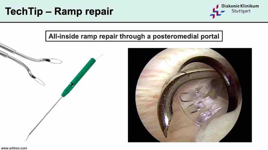 Winglet Originals #007: Complex Meniscal Pathologies – thumbnail 5 of 13