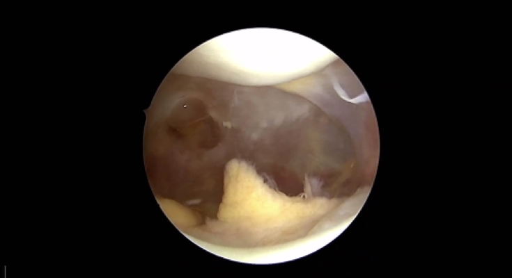 Winglet Originals #014: Basics in Knee Arthroscopy – thumbnail 5 of 19