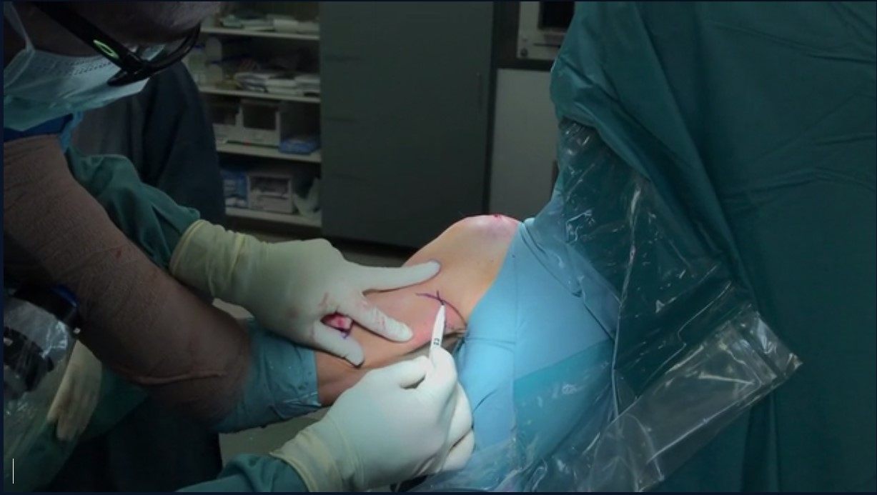 Across the Atlantic: American and European Insights on All Things Biceps Tendon – thumbnail 5 of 16