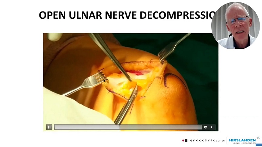 #1212: Insights from the OR - Capsular Release of the Elbow – thumbnail 5 of 8