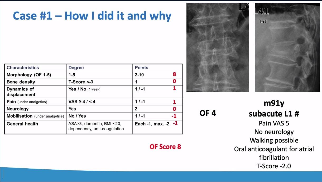 Winglet Originals #020: Minimally-Invasive Fixation of Thoracolumbar Osteoporotic Vertebral Compression Fractures – thumbnail 6 of 13
