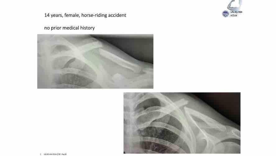 Winglet Originals #005: Clavicle Fractures – thumbnail 6 of 11