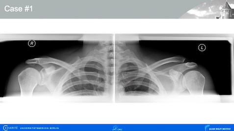 Winglet Originals #003: Acute and Chronic Pathologies of the AC Joint – thumbnail 6 of 11