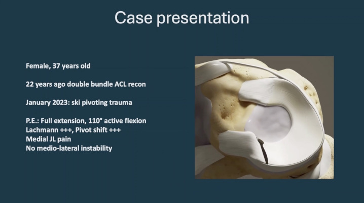ICRS TV Series - #010: Meniscus Lesions: To Operate or Not To Operate? – thumbnail 6 of 10
