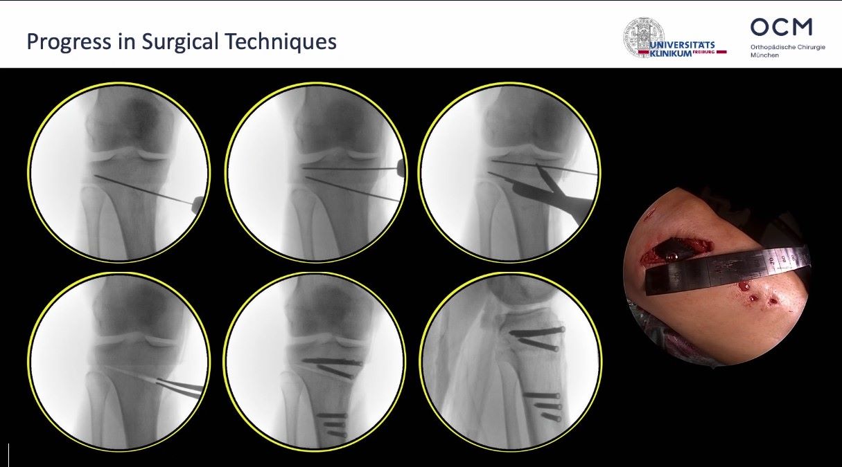 Winglet Originals #022: Osteotomies Around the Knee - Deformity Analysis and its Relevance for Surgical Correction – thumbnail 6 of 12