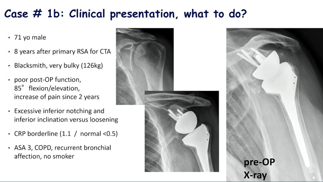 Technology in Shoulder Arthroplasty: Current Developments – thumbnail 6 of 9