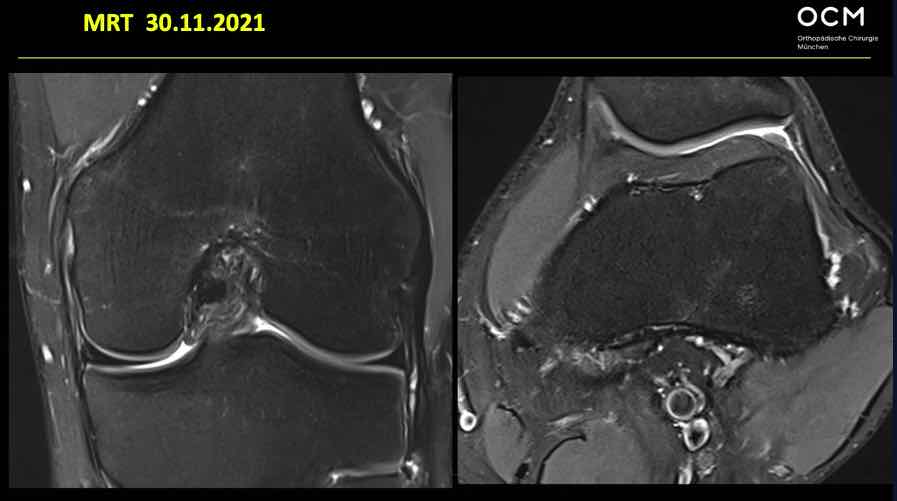 Spezifischer Knieschmerz - Session 1: Instabilitäten – thumbnail 6 of 10