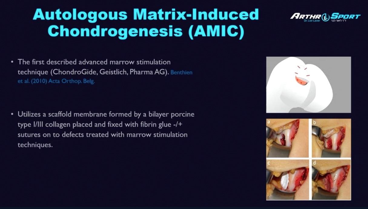 ICRS TV Series - #007: Treatment Options for Articular Cartilage Injuries - An Overview – thumbnail 6 of 10