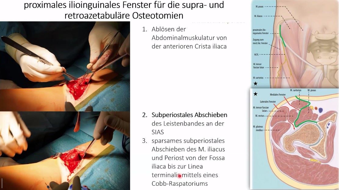 AGAnywhere Monthly - #023: Hüftdysplasie und/oder FAI? – thumbnail 6 of 12