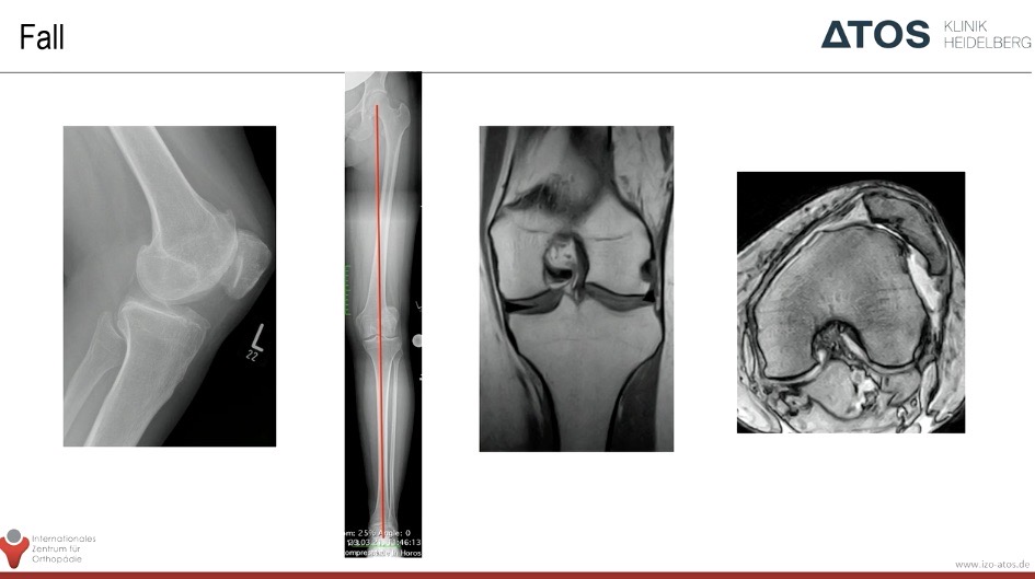 AGAnywhere Monthly - #008: Patellofemorale Instabilität – thumbnail 6 of 12