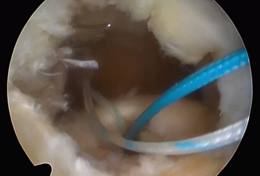 #2611: Update Rotatorenmanschette – thumbnail 6 of 12