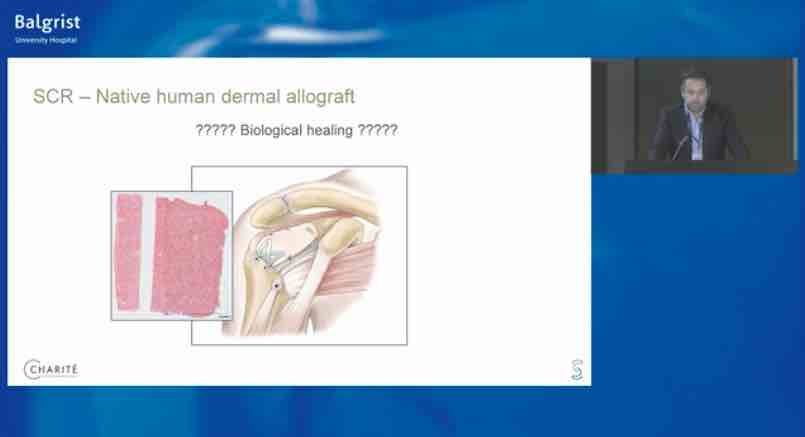 Balgrist International Shoulder Course - Rotator Cuff Disorders – thumbnail 6 of 10