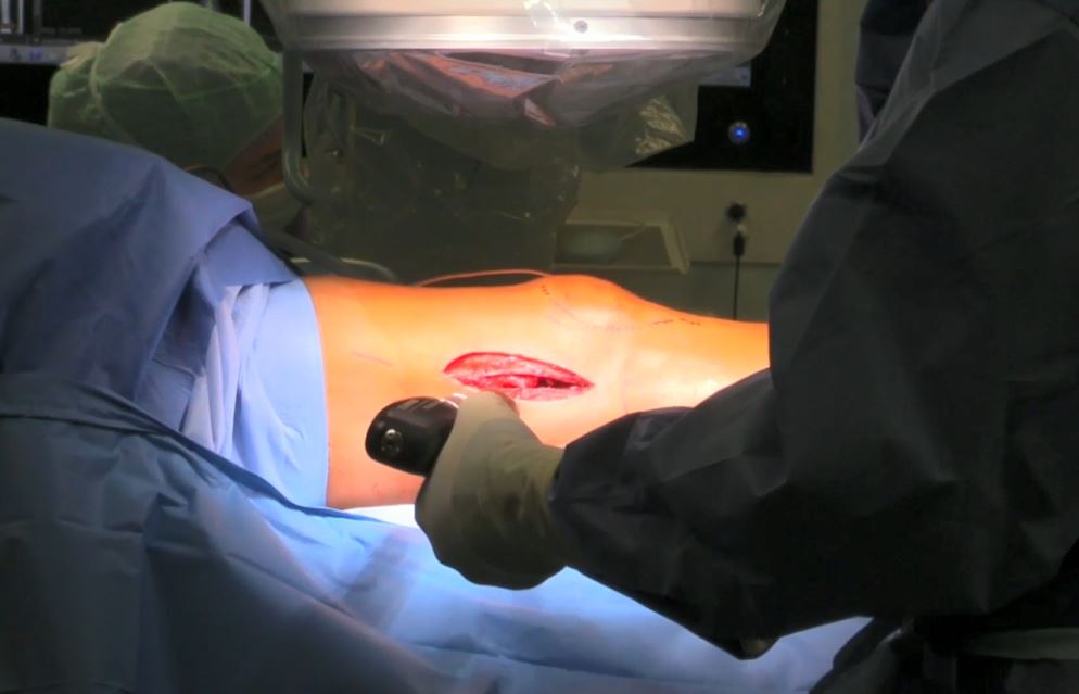 #196: Insights from the OR - Kniegelenknahe Osteotomien – thumbnail 6 of 9