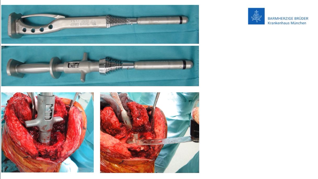 Winglet Originals #015: Revision Knee Arthroplasty – thumbnail 6 of 18