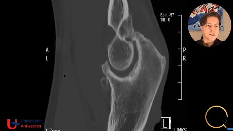 #1212: Insights from the OR - Capsular Release of the Elbow – thumbnail 6 of 8