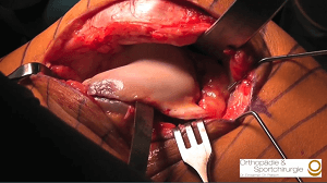 #1010: Insights from the OR - Patellainstabilität – thumbnail 6 of 9