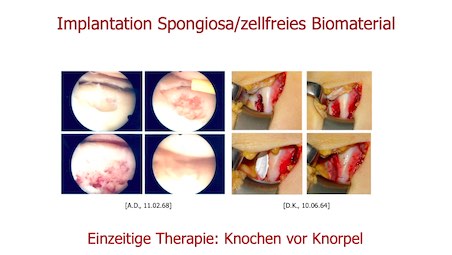 AGAnywhere Monthly - #010: Behandlung von chondralen und osteochondralen Defekten am Kniegelenk – thumbnail 7 of 12