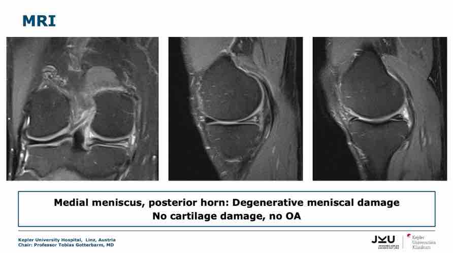 Winglet Originals #007: Complex Meniscal Pathologies – thumbnail 7 of 13