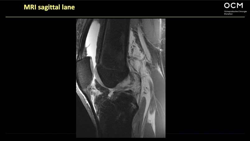 Winglet Originals #001: Acute and Chronic Medial Instabilities of the Knee – thumbnail 7 of 11