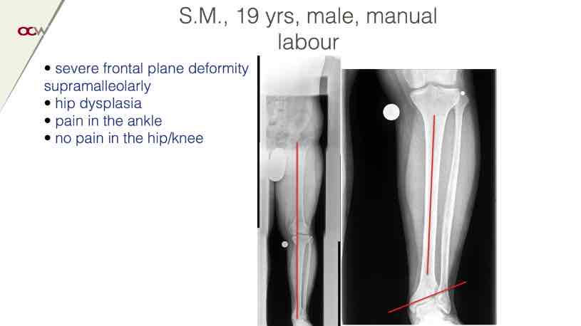 Winglet Originals #004: Malalignment and Early Osteoarthritis of the Ankle – thumbnail 7 of 11