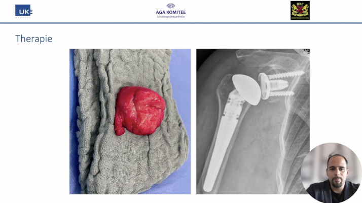 AGAnywhere Monthly - #033: Behandlungsmöglichkeiten der Omarthrose: konservativ - arthroskopisch - Gelenkersatz – thumbnail 8 of 12