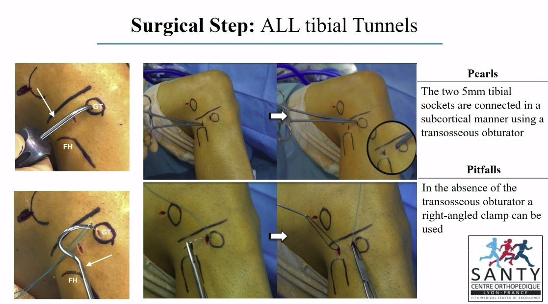 Winglet Originals #012: ACL Reconstruction – thumbnail 7 of 13