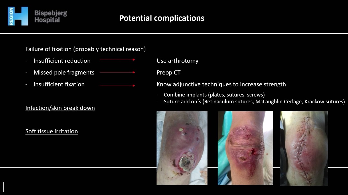 Winglet Originals #016: Patella Fractures – thumbnail 7 of 12