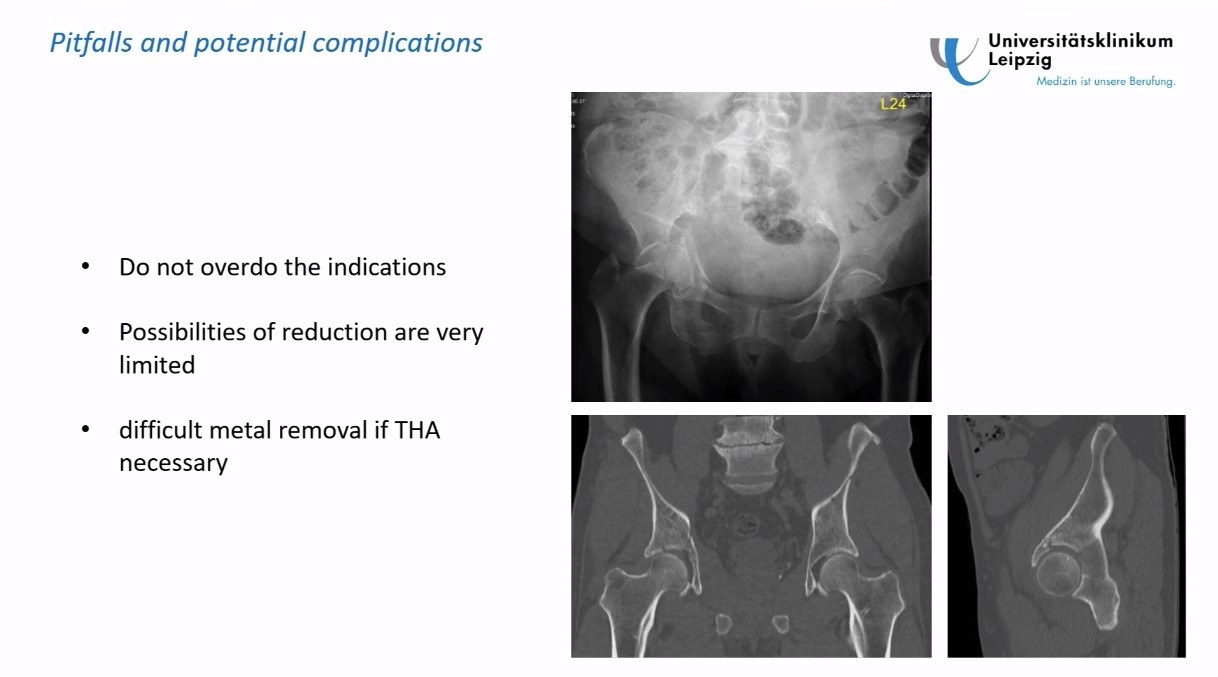 Winglet Originals #018: Minimally Invasive Pelvis & Acetabular Fracture Fixation – thumbnail 7 of 12